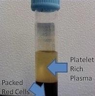 PRP, nuova metodica terapeutica - Medicina Estetica Catania     